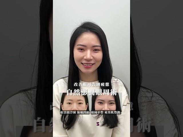 別讓先天條件拉低你的顏值！真實案例分享：眼袋內開移位+自體脂肪補蘋果肌｜晶華美醫診所、晶心美醫集團、整形外科鄭穎醫師