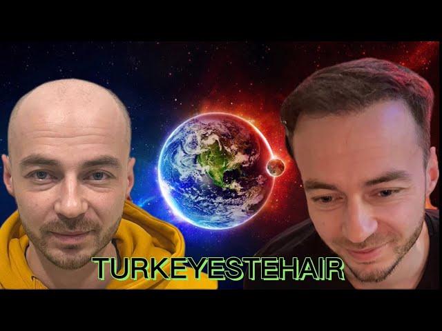 Пересадка волос в Москве. Результат от Turkeyestehair