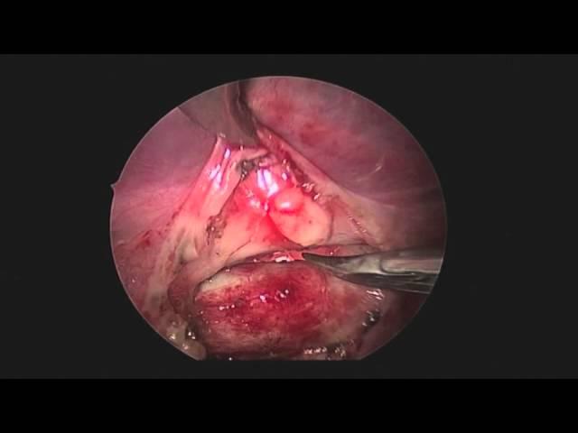 Chylothorax (Minimally Invasive) Great Dane (Dr. Jeffrey J Runge DVM, DACVS)