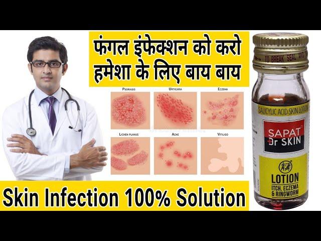 Sapat Dr Skin Lotion Review | Sapat Lotion For Fungal infection | Sapat Lotion for itch , Eczema