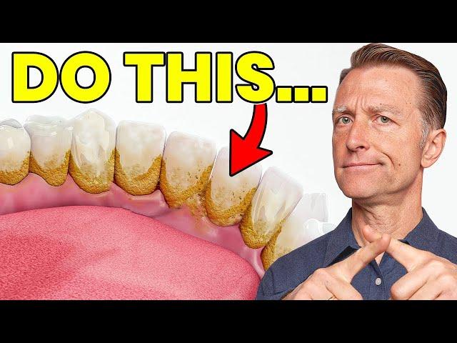 The #1 Top Remedy for Dental Plaque (TARTAR)