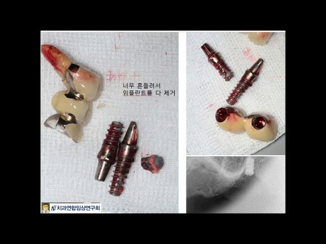 2-56.  IBS 임플란트와 임플란트 재수술 콜라보 (부산 광안리 뉴욕치과)