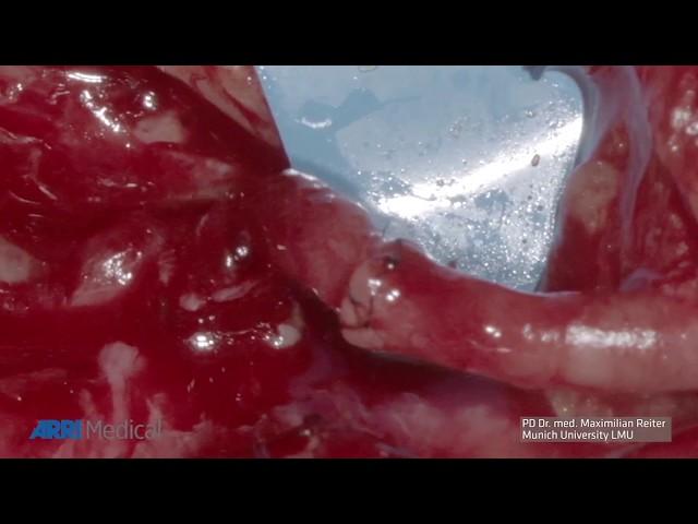 ARRISCOPE Application Video - Microvascular Anastomosis