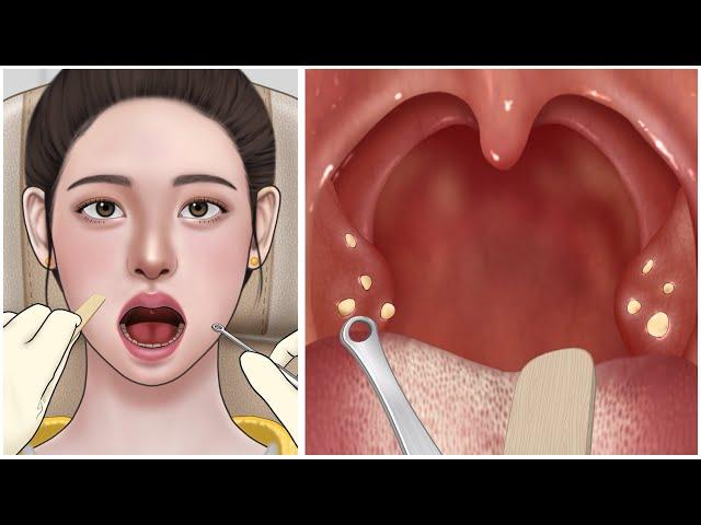 [ASMR] Cause of bad breath! Tonsil stone removal animation