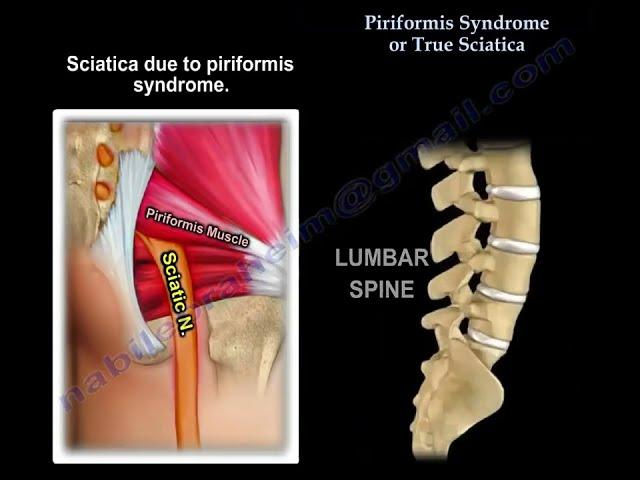 Piriformis syndrome  or disc herniation, how do you tell the difference ? a confusing presentation