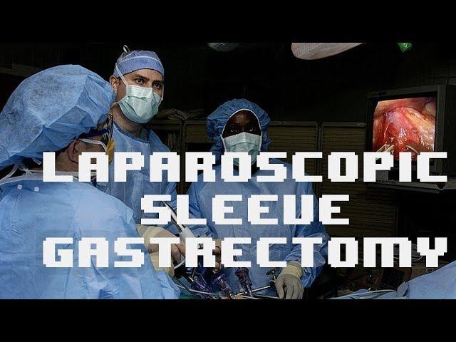 Laparoscopic sleeve gastrectomy