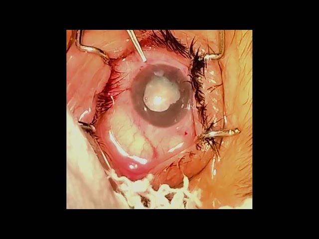 AIOCMT3 2024 - VT152 - Prof. Dr. Manisha Nada - Clearing the Haze: Surgical Approach to Unilateral..