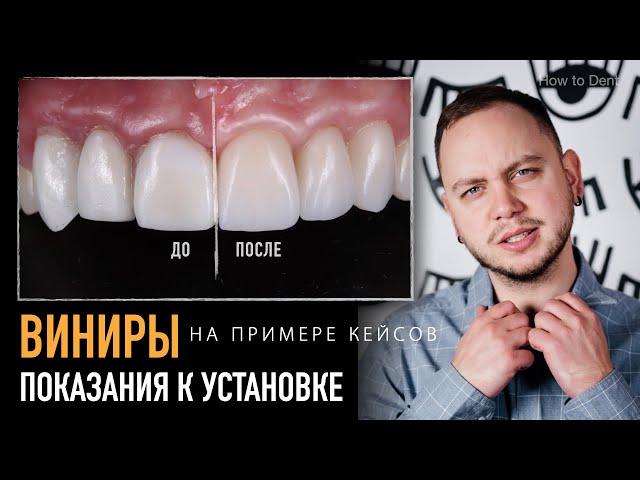 Показания для установки виниров. Что можно исправить с помощью виниров?