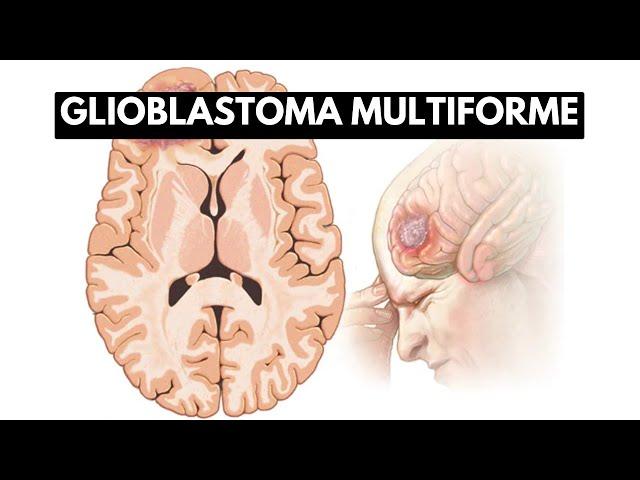 Inside Glioblastoma Multiforme: A Journey into the Deadliest Brain Tumor