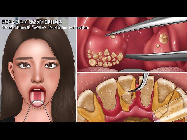 ASMR Extreme Tonsil Stone Treatment & Giant Tartar Removal Animation | White Tongue