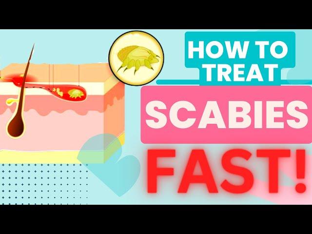 HOW TO TREAT SCABIES FAST! TREATMENT AND HOME REMEDIES