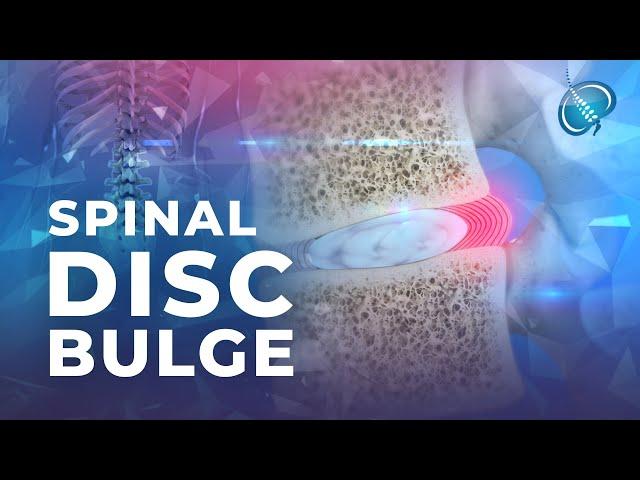 What Is a Bulging Disc?