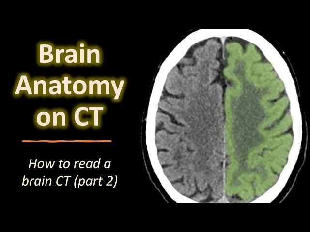 How to read a brain CT (part 2): Brain anatomy on CT