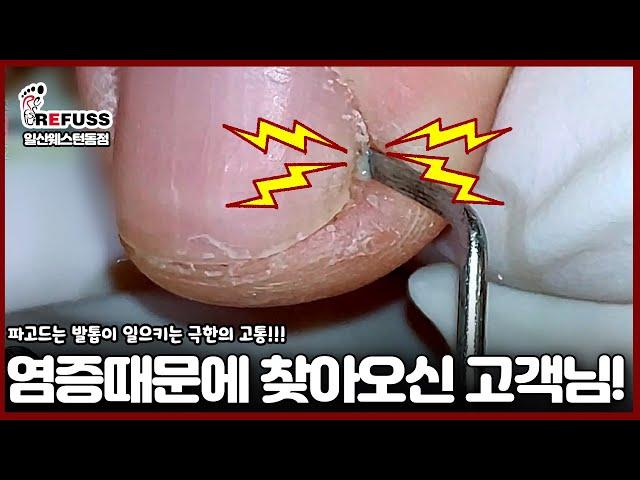 파고드는 발톱이 일으키는 극한의 고통! 염증때문에 오셨어요ㅠㅠ #레푸스 #일산레푸스 #내성발톱 #무좀발톱 #ingrown_toenail #일산내성발톱 #일산무좀발톱 #발톱
