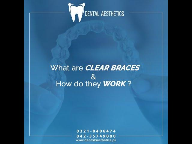 Clear Braces - Dental Aesthetics