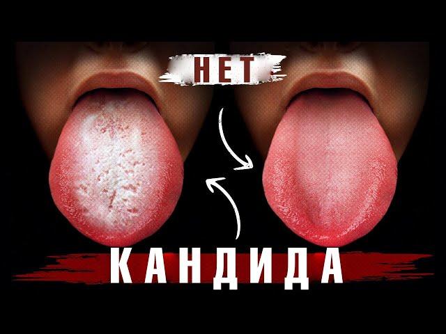 Начните делать это сейчас – и избавитесь от кандидоза навсегда!