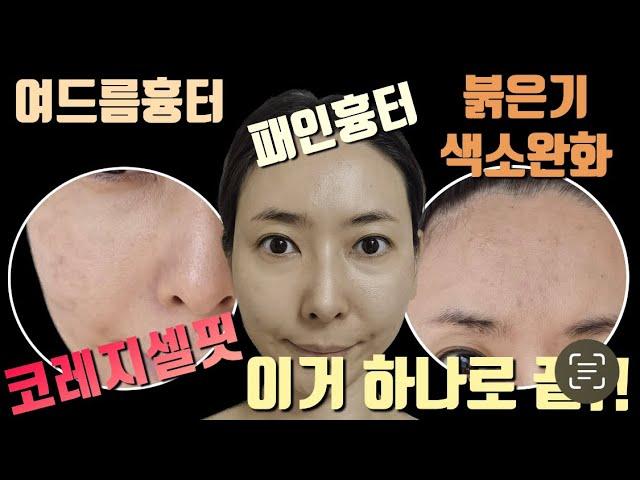 여드름흉터, 패인흉터, 붉은기 완화 레이저‼️ 자극없는 관리추천‼️ 코레지셀핏 시술 상세후기⁉️