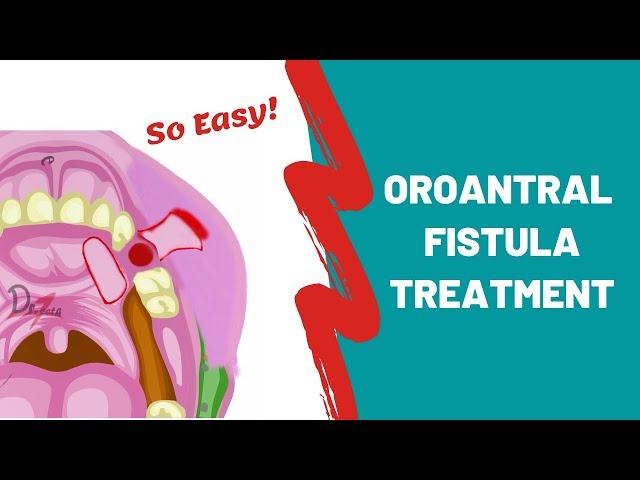 Oroantral Fistula | Treatment Options | ORAL SURGERY