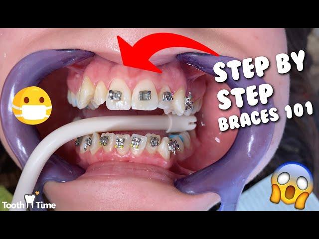 Dental Braces - Step by Step - Tooth Time Family Dentistry New Braunfels