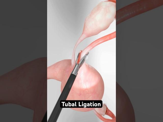 Three methods for permanent female sterilization (3D Animation)