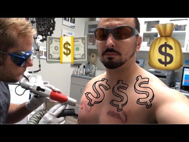 Laser Tattoo Removal COST | HOW MUCH