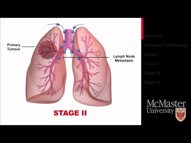 Lung Cancer: Staging Presentation