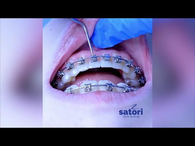 Снятие брекетов | стоматология  Самара | braces off