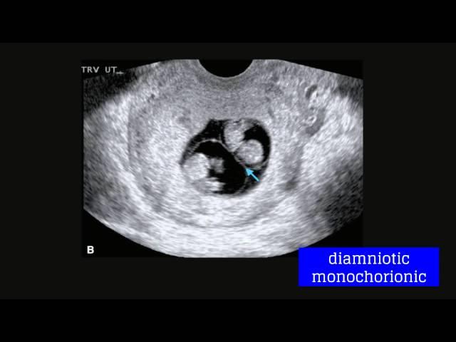 Topic 20: Multifetal Gestation