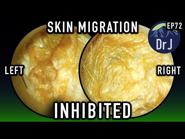 EP 72 : SKIN MIGRATION : INHIBITED BY HEARING AIDS : CAUSES MALFUNCTION 4K/HD