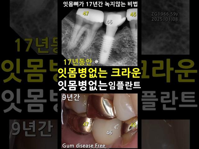 잇몸병 없는 크라운. 잇몸병 없는 임플란트. 지르코니아 나사유지형 임플란트 안하니까 잇몸뼈파괴없음. 브리지제거시 김문수스타일. 크라운수명 임플란트수명 59세치아 2025_05_14
