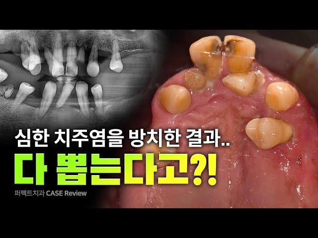 50대 남성 치주염 전악임플란트 | 발치 임플란트 00개