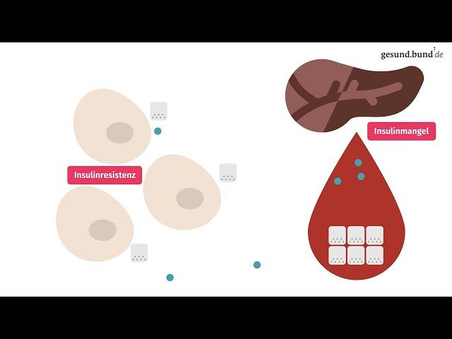 Was ist Typ-2-Diabetes?