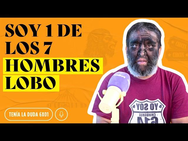 Me llaman "HOMBRE LOBO": ¿Por qué nací así?