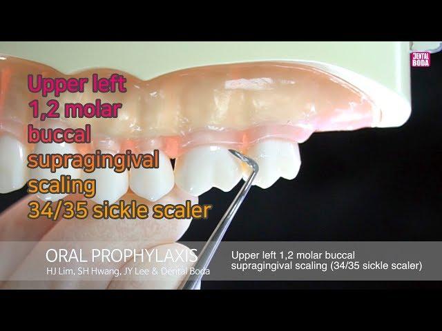 Upper left 1,2 molar buccal supragingival scaling 34/35 sickle scaler