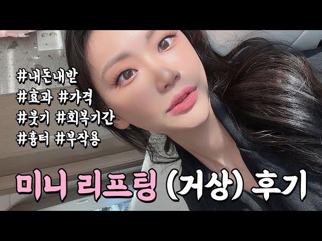 vlog  미니리프팅(미니거상) 내돈내산 시술 후기 브이로그. (효과, 가격, 붓기, 회복기간, 흉터, 부작용, 전후 다 알려줌)