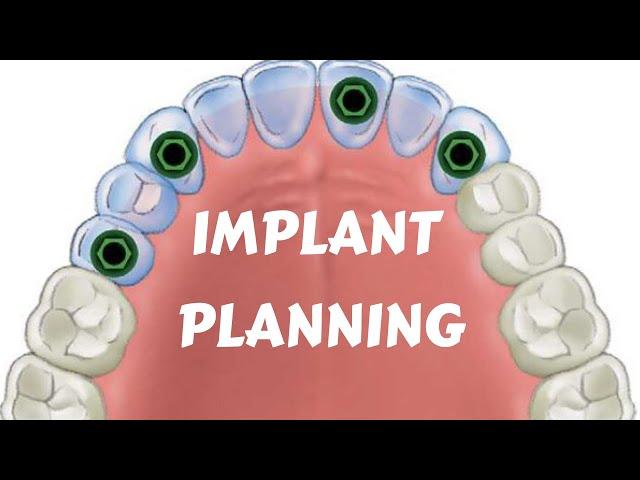 Dental Implant Lecture | Implant Treatment Planning | Key Implant position I Edentulous Arch