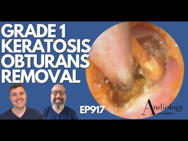 GRADE 1 KERATOSIS OBTURANS REMOVAL - EP917