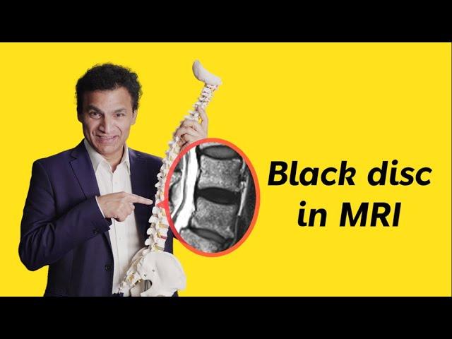 What is a "Black disc" on a Spine MRI scan?