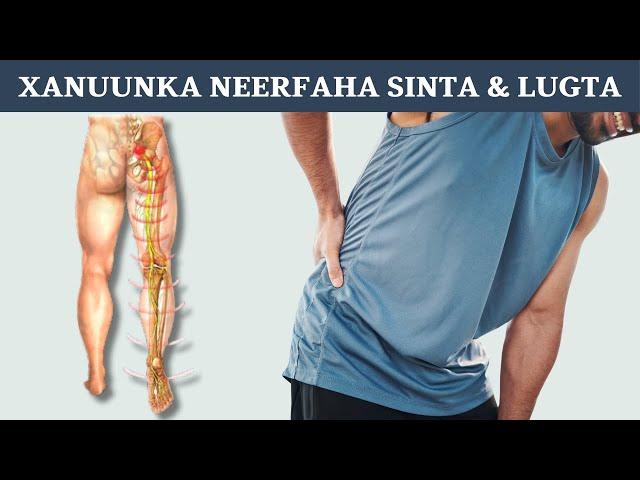 Dawaynta Xanuunka Neerfaha Sinta Iyo Lugta ee Loo Yaqaano Sciatica