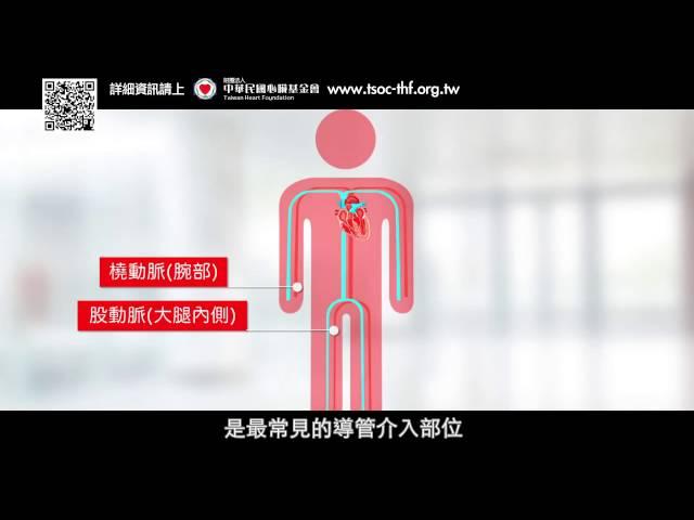 冠心病小學堂part5 – 心導管手術的介紹