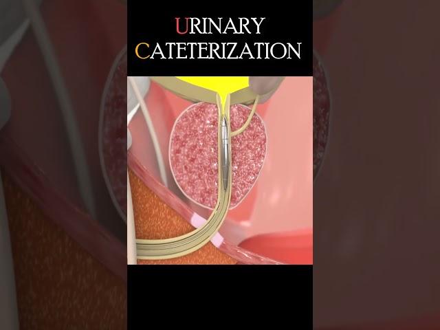 Urinary Catheterization Procedure #shorts