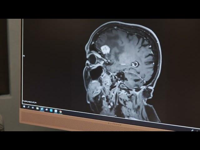 Brain Tumor Treatment Without a Scalpel at Acıbadem, Türkiye