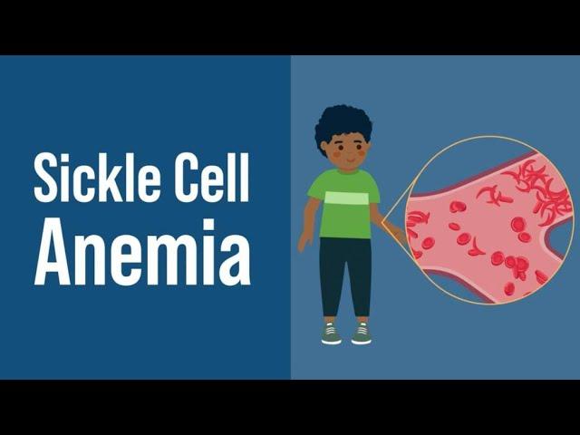 Sickle Cell Anemia