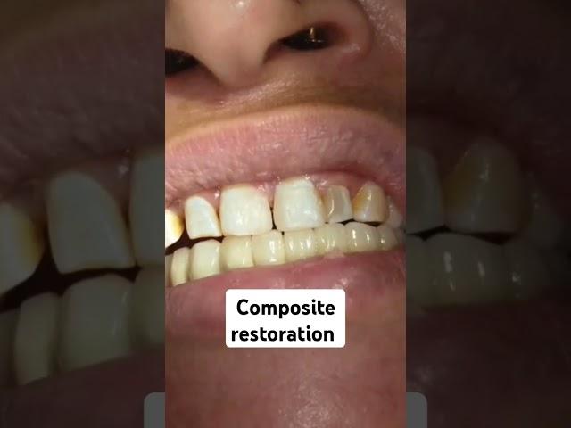 composite restoration #dental #music #electronic #ambientmusic #relaxingmusic #dentist