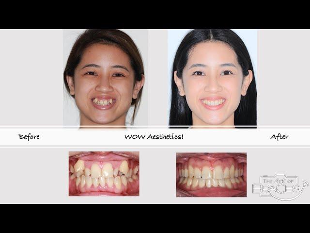 Severe dental crowding corrected with braces and extractions in 28 months