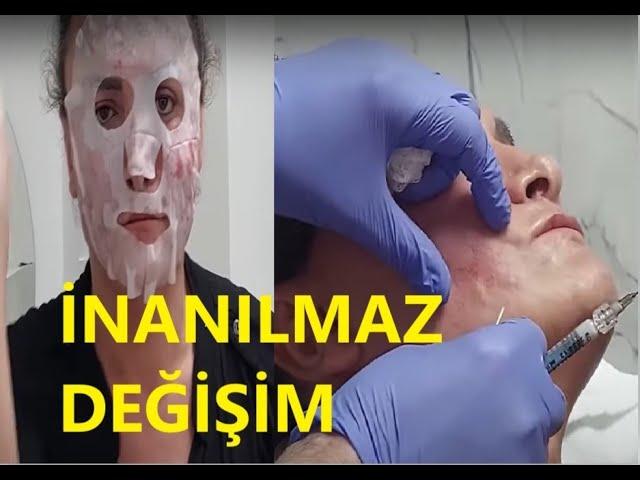 YÜZ DOLGUSU İLE DÜNYA GÜZELİ OLDU