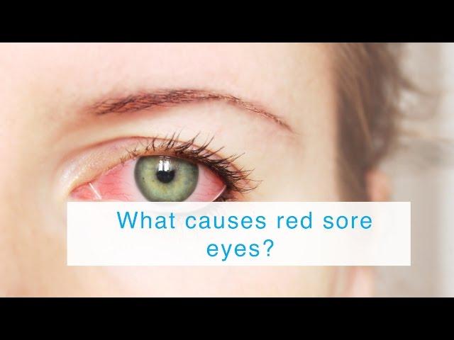 What causes red sore eyes?