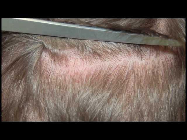 Przeszczep włosów metodą FUE (Follicular Units Extraction)