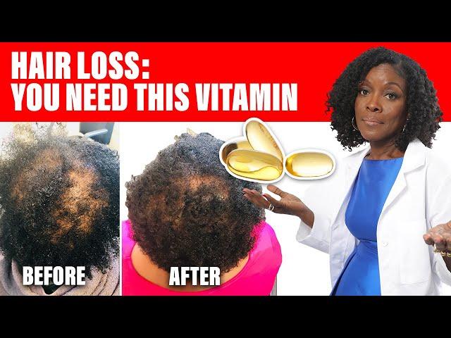 Hair Loss: This Vitamin  Can Save Your Hair