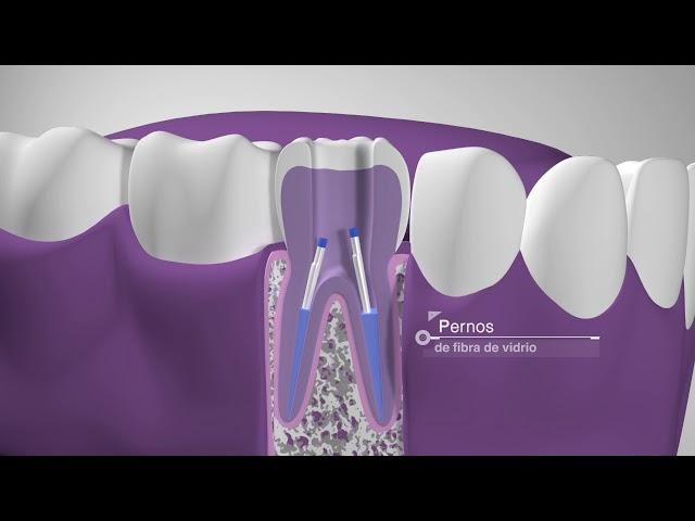 Endodoncia, qué es y cómo se realiza. DENTIX